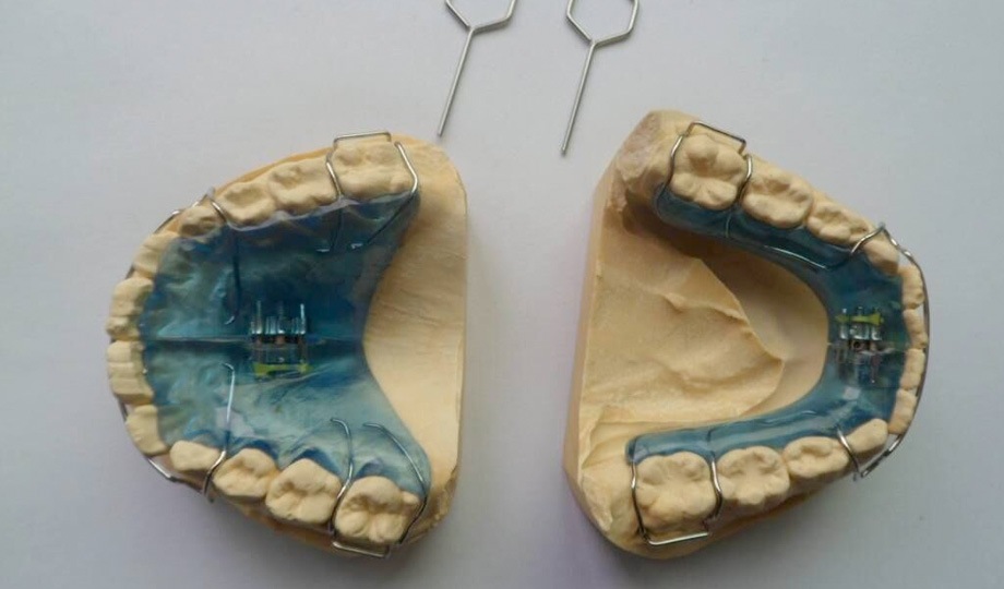 Rapid Palatal Expander in Children's Orthodontics