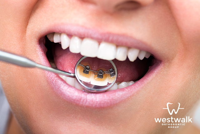 Lingual braces will bo on the backside of your teeth so they'll remain out of sight
