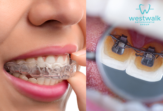 What Are the Various Types of Braces?