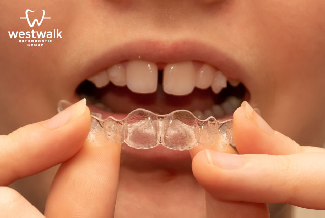 Orthodontic Alternative Options to Correct Teeth Gap Malocclusions in Norwalk