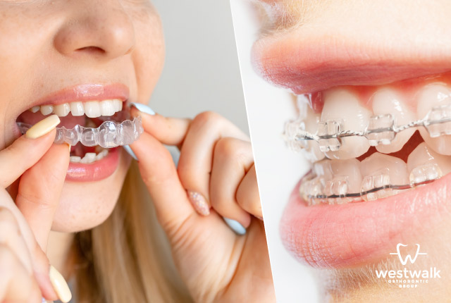 In the clear ceramic braces vs Invisalign clear aligners the winner is the one that suits your needs and budget best.